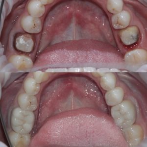 Восстановление жевательных зубов коронками до и после