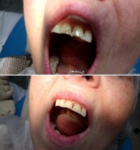 Реставрация передних зубов до и после