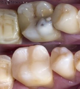Лечение зуба до и после