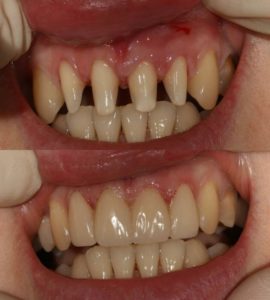 Протезирование и установка коронок в Невской стоматологии